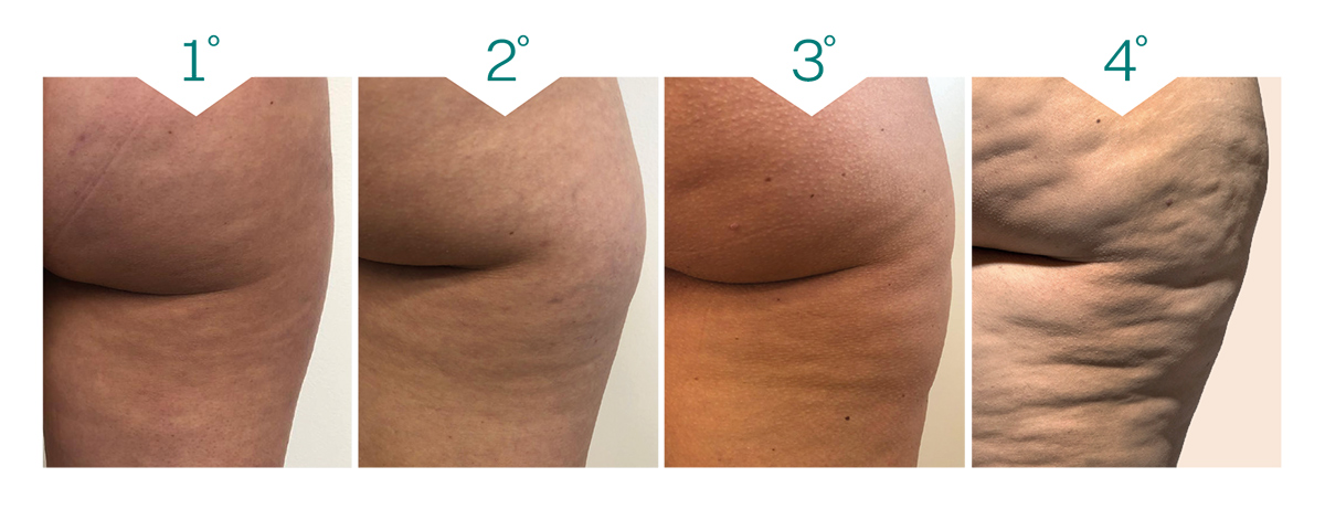 rimedi efficaci contro la cellulite